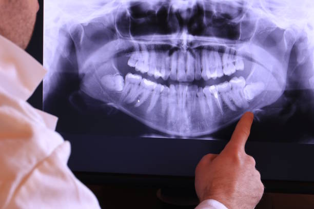 Best Emergency Wisdom Teeth Removal in Ingalls Park, IL